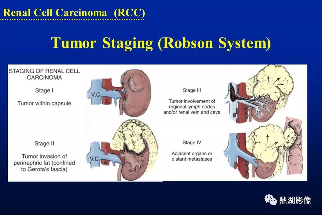 肾癌最新分级详解，深入理解与治疗方案策略探讨